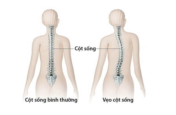 Nguyên nhân và các dạng cong vẹo cột sống thường gặp