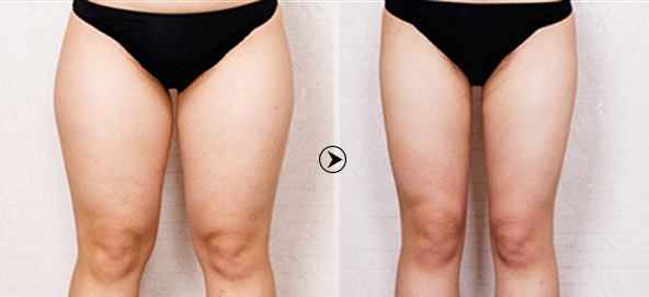 Câu Hỏi Chạy Bộ Có Làm To Chân?